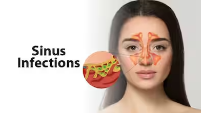 Are sinus infections contagious?